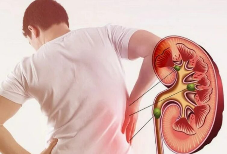 Read more about the article Báo động đỏ: Giới trẻ ngày càng mắc suy thận mạn, nguyên nhân do đâu?